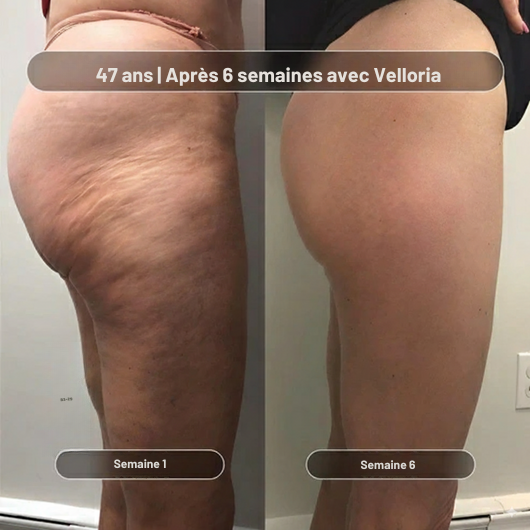 Huile de massage anti-cellulite